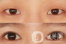 韓式三點法割雙眼皮手術(shù)的價格一般是多少