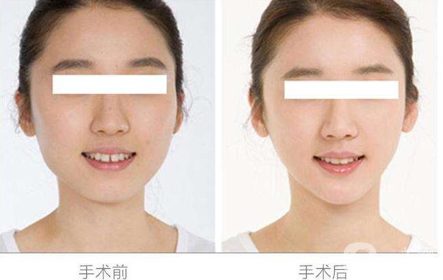 自體脂肪,墊下巴,自體脂肪墊下巴,北京自體脂肪墊下巴,北京自體脂肪墊下巴多少錢