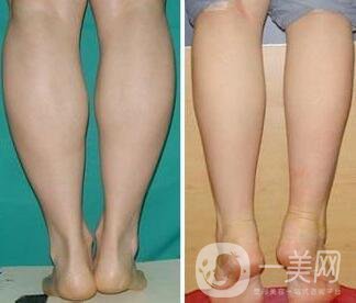 射頻瘦小腿保持多久?纖細雙腿不是夢美
