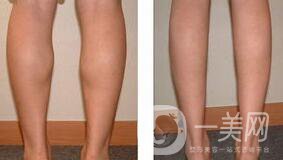 射頻瘦小腿保持多久?纖細雙腿不是夢美