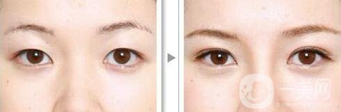 重慶割雙眼皮需要花多少錢呢