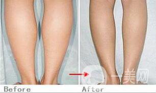 瘦小腿手術(shù)是怎么樣的，具體方法有哪些