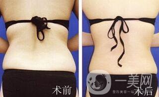 后背吸脂后多久消腫？吸脂術(shù)后如何護(hù)理
