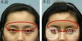 假體豐眉弓術(shù)后處理 怎么進(jìn)行術(shù)后護(hù)理