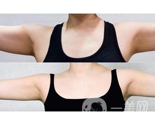 上臂吸脂減肥手術(shù)有危險(xiǎn)嗎