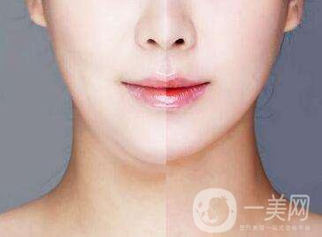 雙下巴吸脂多少錢？價格盤點！