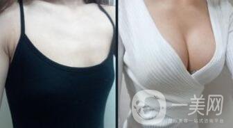 豐胸要注意什么?豐滿身材的秘密