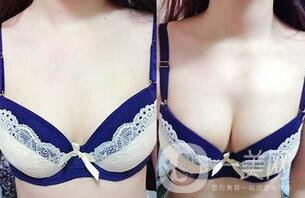 脂肪隆胸失敗如何修復(fù)？隆胸修復(fù)多少錢