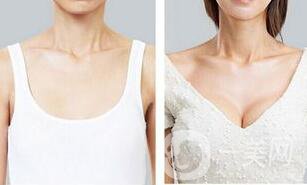 脂肪隆胸失敗如何修復(fù)？隆胸修復(fù)多少錢