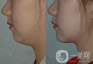 雙下巴吸脂注意事項(xiàng)介紹 雙下巴吸脂多少錢