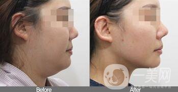 雙下巴吸脂注意事項(xiàng)介紹 雙下巴吸脂多少錢