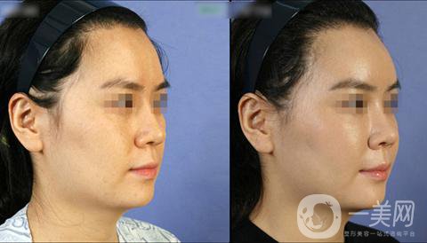 假體墊眉弓整形之后有沒有后遺癥