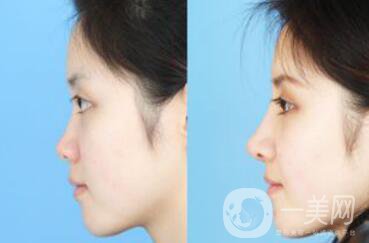 *一個(gè)月定型了嗎？*手術(shù)價(jià)格多少