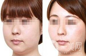 光纖溶脂去雙下巴注意事項(xiàng)詳解