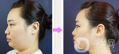 光纖溶脂去雙下巴注意事項(xiàng)詳解