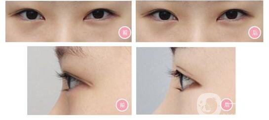 成都開內(nèi)外眼角,開內(nèi)外眼角多少錢,開眼角價格