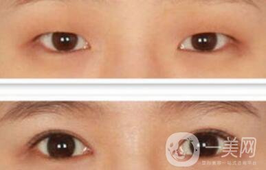 開(kāi)眼角幾天恢復(fù)？開(kāi)眼角手術(shù)費(fèi)用介紹