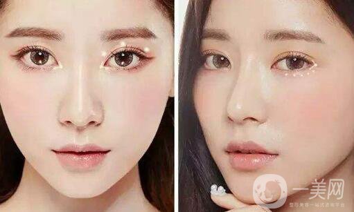 *手術(shù)恢復(fù)期是多久