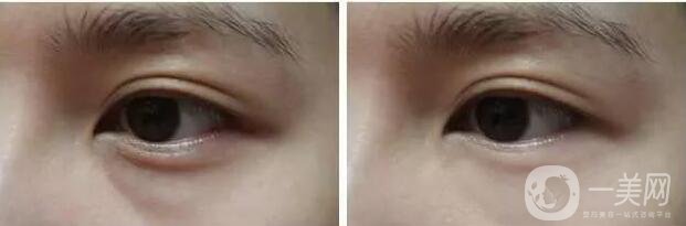 去眼袋,光乳化去眼袋,光乳化去眼袋多少錢