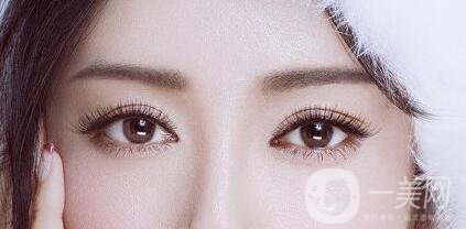 全切雙眼皮多久恢復？