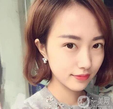 雙眼皮手術拆線后要怎樣護理 1