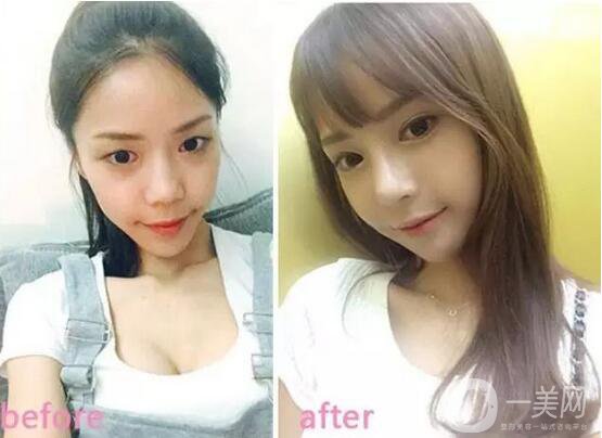 雙眼皮手術拆線后要怎樣護理 2