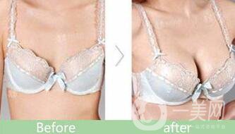 硅膠隆胸能管多久？隆胸手術(shù)具體費用