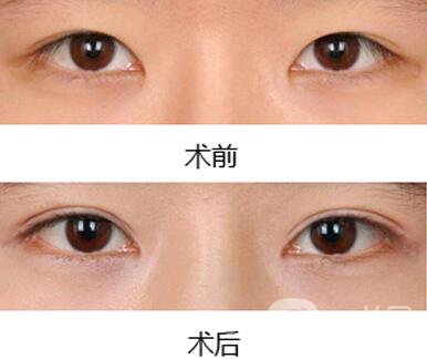雙眼皮增生了怎么處理？雙眼皮修復價格多少