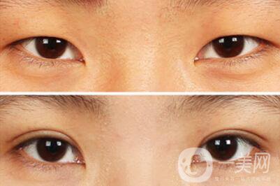 雙眼皮增生了怎么處理？雙眼皮修復價格多少