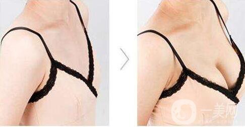 隆胸,隆胸注意事項(xiàng)