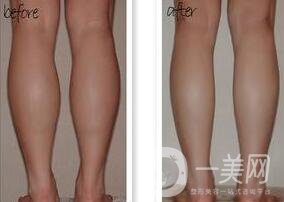 吸脂瘦小腿的危害具體有哪些