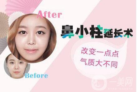 鼻小柱延長,鼻小柱延長費用,廣東鼻小柱延長費用
