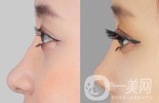 *后吃什么消腫快