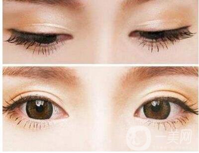 開眼角,開眼角增生,眼角增生修復費用