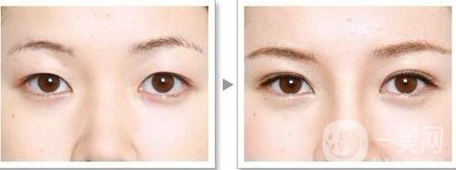 全切雙眼皮增生期是多久