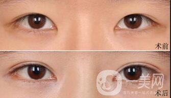 雙眼皮拆線多久用疤克