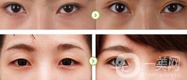 雙眼皮拆線多久用疤克