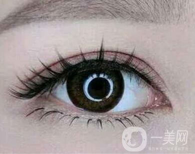 雙眼皮埋線前注意什么？