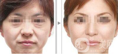 杭州做電波拉皮去皺的價格多少