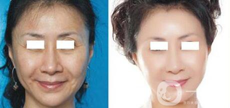 杭州做電波拉皮去皺的價格多少