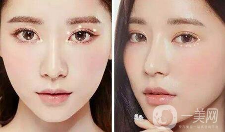 雙眼皮拆線后怎么護理？