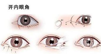 北京做開(kāi)眼角手術(shù)多少錢(qián)