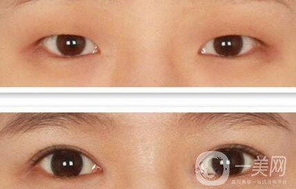 北京做開(kāi)眼角手術(shù)多少錢(qián)