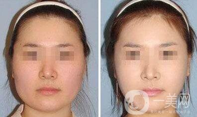 去頰脂墊瘦臉術(shù)后護理怎么做？