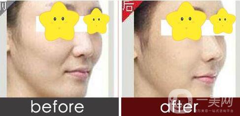 自體脂肪去法令紋,自體脂肪去法令紋多少錢,北京自體脂肪去法令紋多少錢