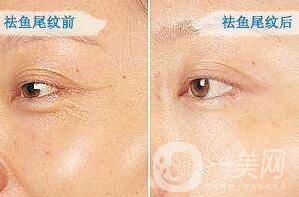 深圳去除魚尾紋,去除魚尾紋,去除魚尾紋多少錢