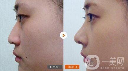 自體脂肪墊山根危害主要有哪些 