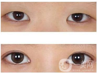 開(kāi)眼角手術(shù)之后會(huì)疤痕增生嗎
