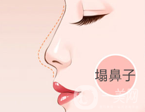 假體隆鼻手術(shù)之后多久可以修復