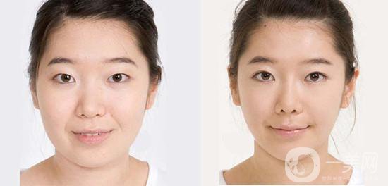 激光溶脂瘦臉多久見*